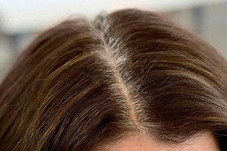 Saçın erkən ağarmasının əsas səbəblərindən biri