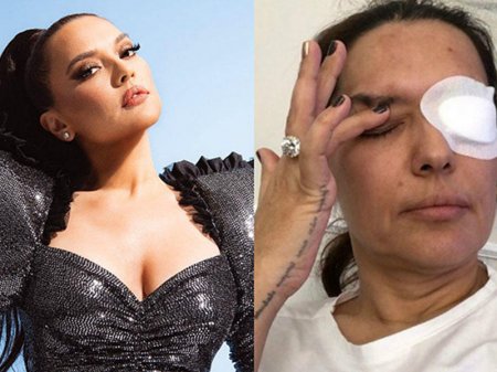 Demetin gözünə nə olub?